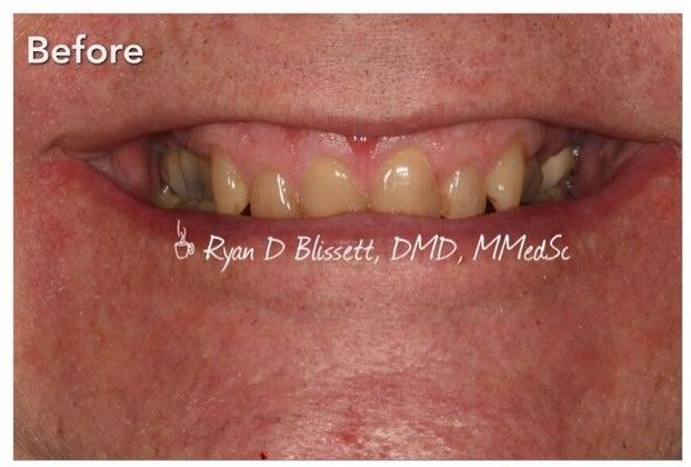 Porcelain Crowns Case 10 - Before