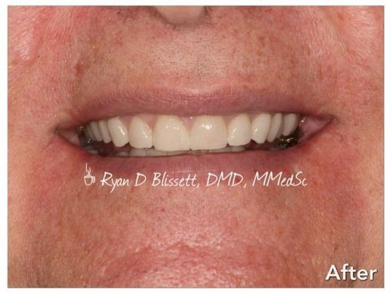 Porcelain Crowns Case 10 - After