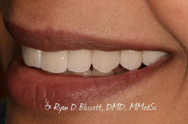 Porcelain Crowns: Case 11 - After