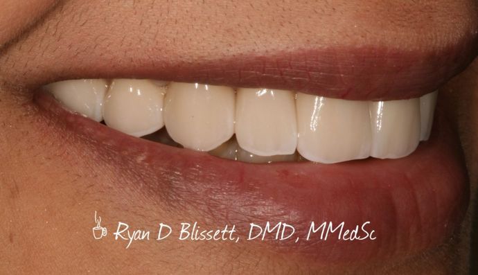 Porcelain Crowns: Case 11 - Before