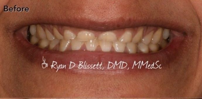 Porcelain Crowns Case 11 - Before