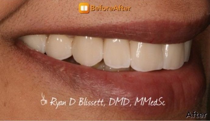 Porcelain Crowns Case 11 - After