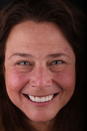 Porcelain Crowns: Case 12 - After