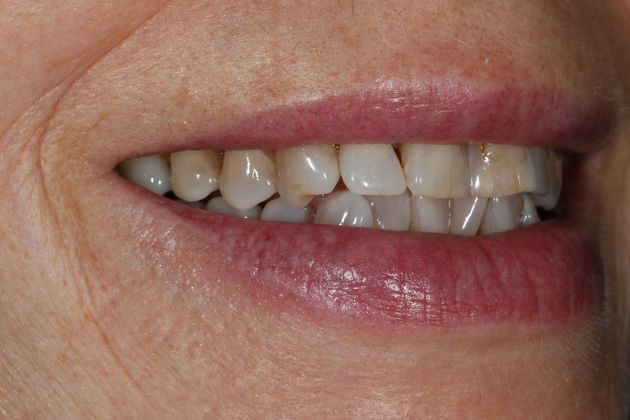 Porcelain Crowns Case 12 - Before