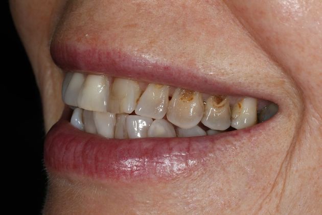 Porcelain Crowns: Case 12 - Before