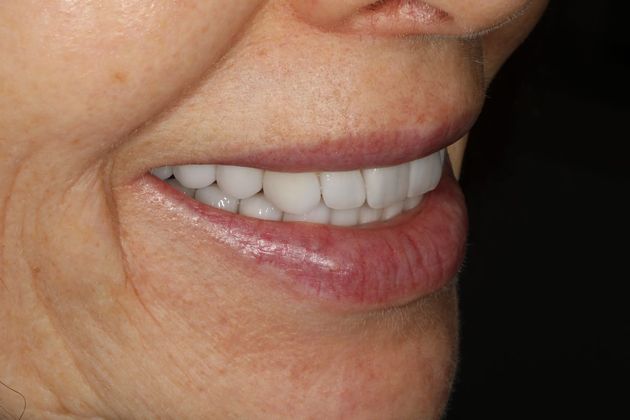 Porcelain Crowns Case 12 - After