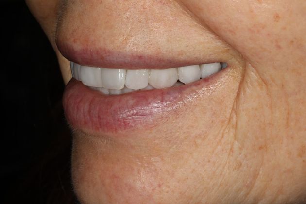 Porcelain Crowns: Case 12 - After