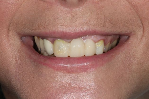 Porcelain Crowns: Case 12 - Before