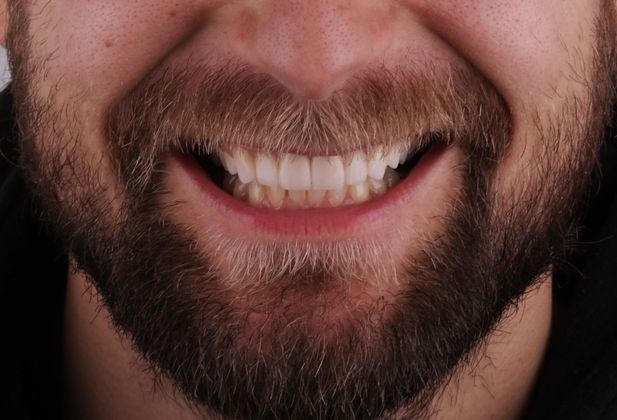 Porcelain Veneers Case 9 - After