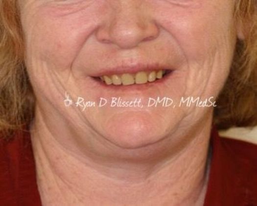 Porcelain Crowns Case 13 - Before