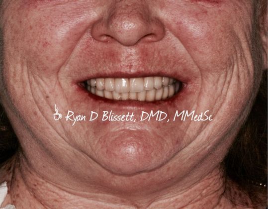 Porcelain Crowns Case 13 - After