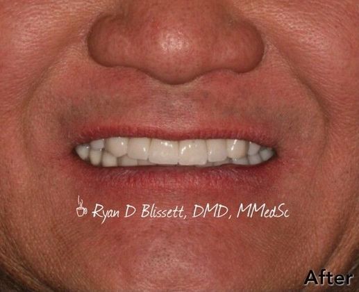 Porcelain Crowns Case 14 - After