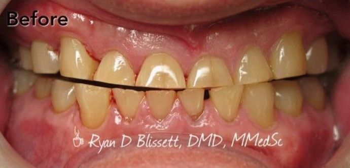 Porcelain Crowns Case 14 - Before