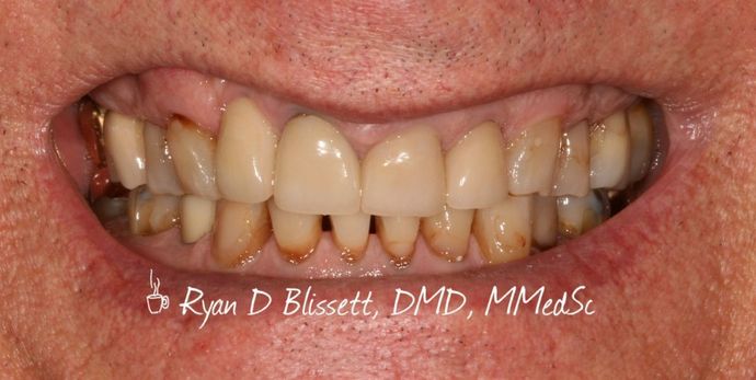 Porcelain Crowns: Case 15 - Before