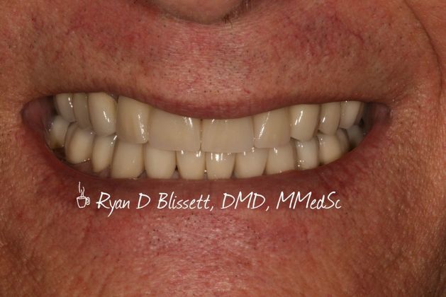 Porcelain Crowns: Case 15 - After