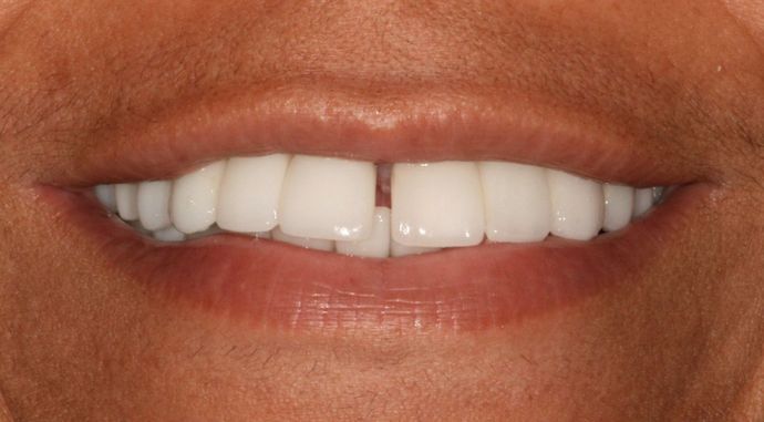Porcelain Veneers Case 10 - Before
