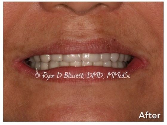 Porcelain Crowns Case 17 - After