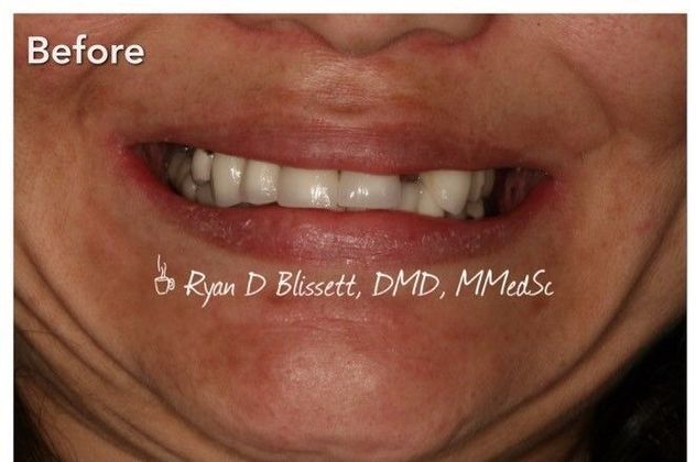 Porcelain Crowns Case 17 - Before