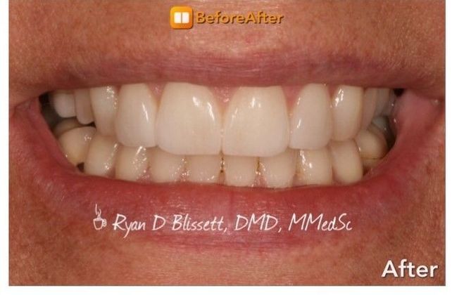 Porcelain Veneers Case 11 - After