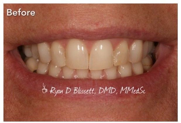 Porcelain Veneers Case 11 - Before