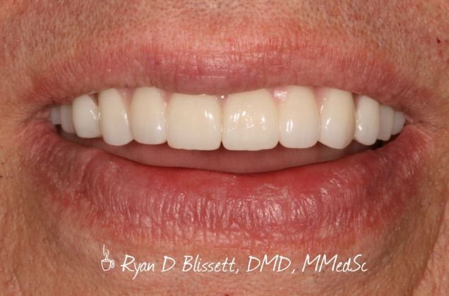 Porcelain Crowns Case 18 - After