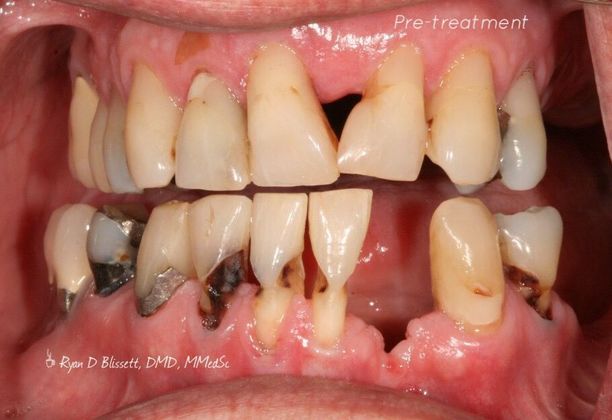Porcelain Crowns Case 18 - Before
