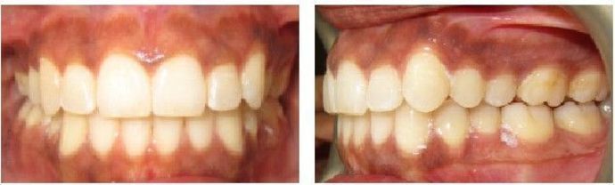 Braces and Invisalign Cases  Case 1 - After