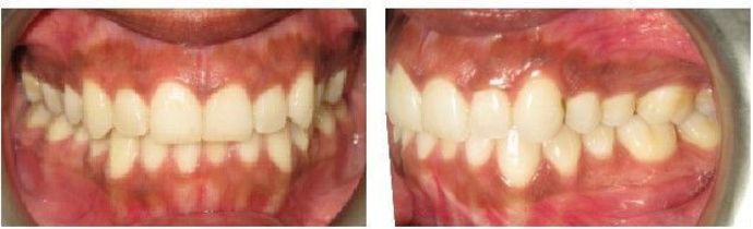 Braces and Invisalign Cases  Case 1 - Before