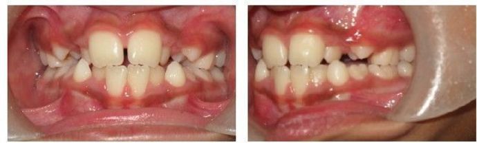 Braces and Invisalign Cases  Case 2 - Before