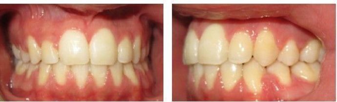 Braces and Invisalign Cases  Case 2 - After
