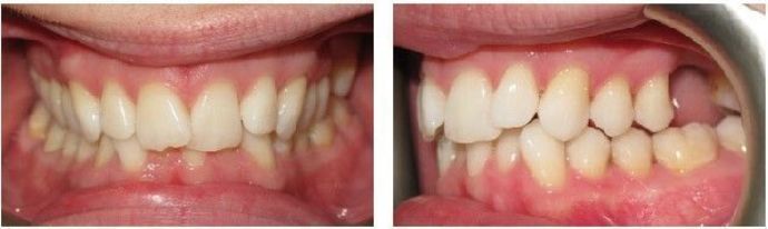 Braces and Invisalign Cases  Case 3 - Before