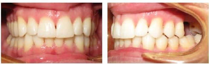 Braces and Invisalign Cases  Case 3 - After