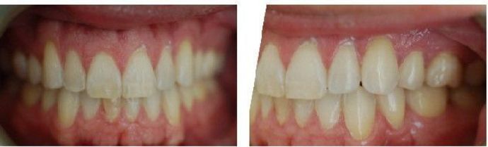 Braces and Invisalign Cases  Case 4 - After