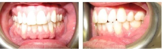 Braces and Invisalign Cases  Case 4 - Before