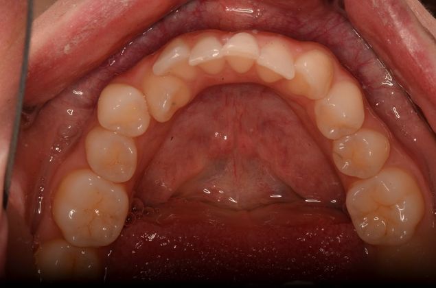 Invisalign Case 15 - Before