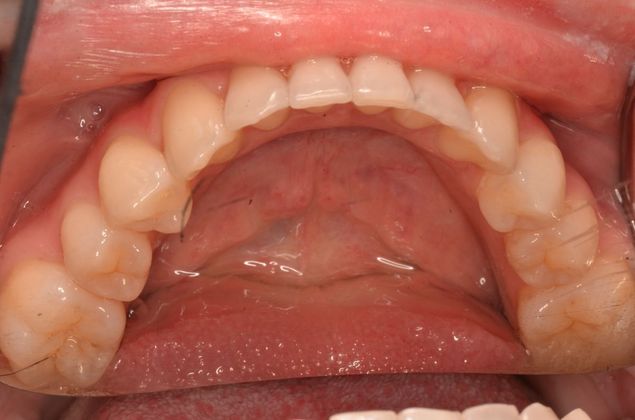 Invisalign Case 15 - After