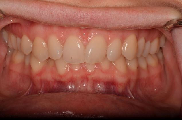 Invisalign: Case 15 - Before