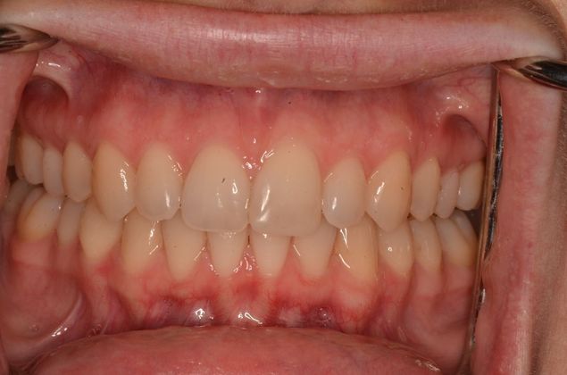Invisalign: Case 15 - After