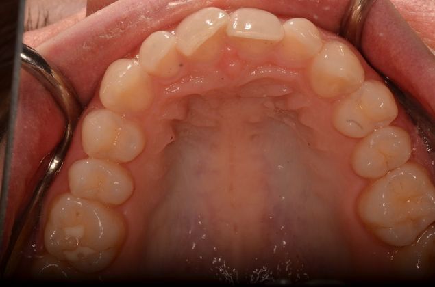 Invisalign: Case 15 - Before
