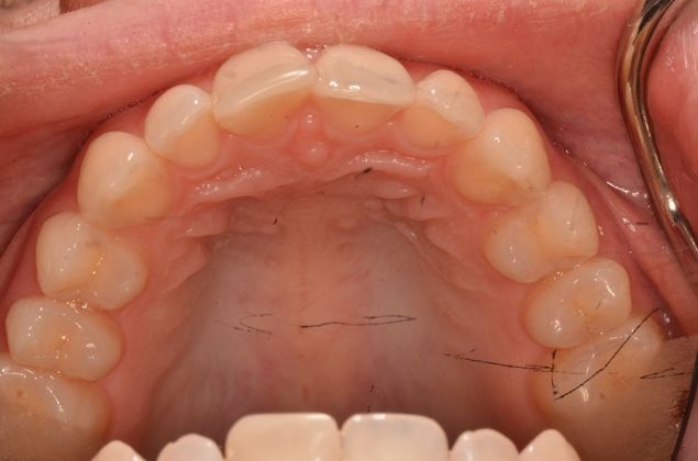 Invisalign: Case 15 - After
