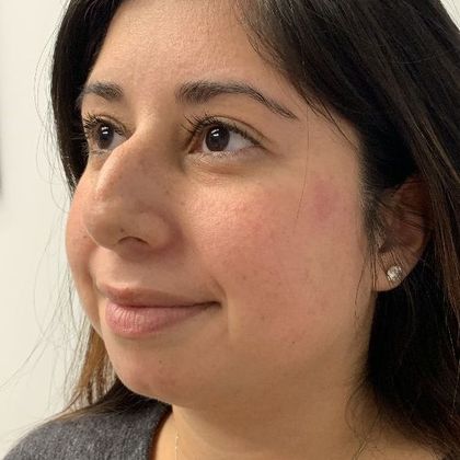 Rhinoplasty: Case 15 - Rhinoplasty Waterbury, CT - Before