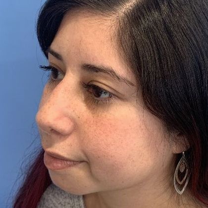 Rhinoplasty: Case 15 - Rhinoplasty Waterbury, CT - After