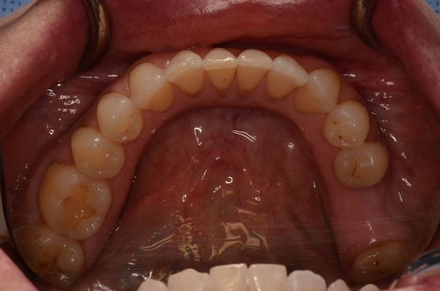 Dental Implants Case 48 - Before