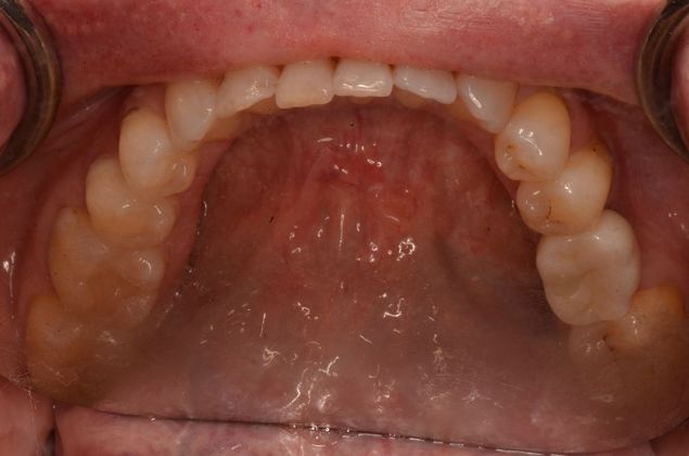 Dental Implants Case 48 - After