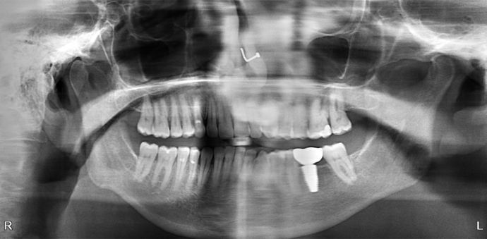 Dental Implants: Case 48 - 5 year old implant and crown