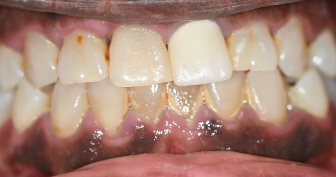 Crowns Case 19 - Victoria, TX - Before