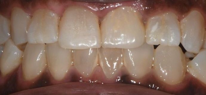 Crowns Case 19 - Victoria, TX - After