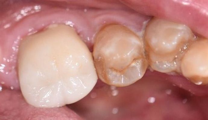 Crowns Case 20 - Vanderbilt, TX - After