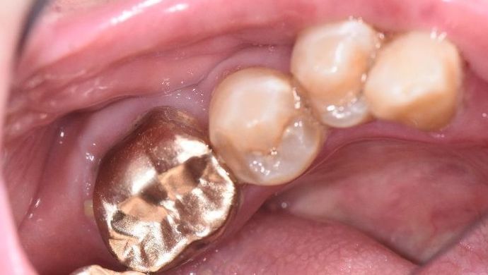 Crowns Case 20 - Vanderbilt, TX - Before