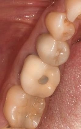 Crowns Case 21 - Beeville, TX - Before